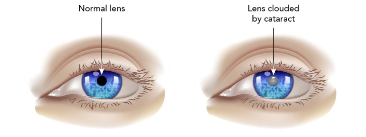 An eye with a normal lens and an eye with a lens clouded by cataract